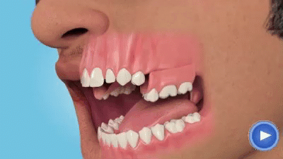web pack 343 – обработка зуба для фиксации съемного протеза