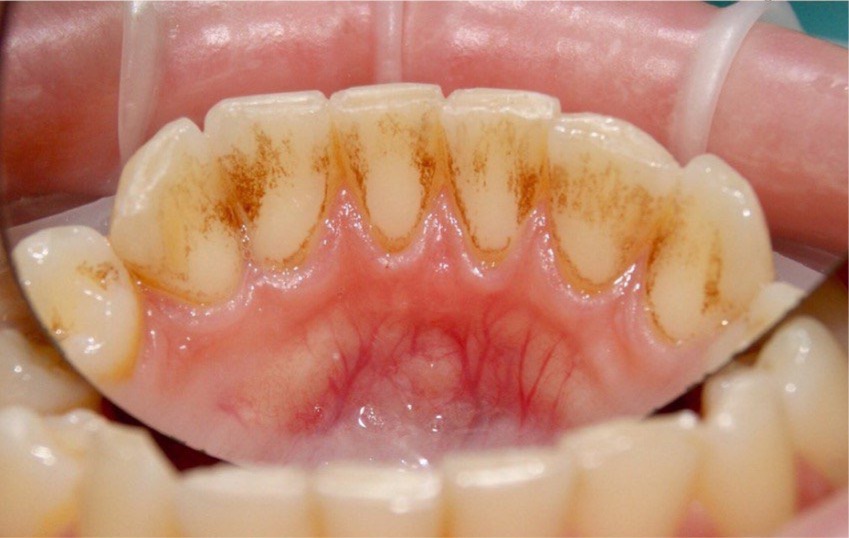 *непросто удалить весь зубной налёт даже с внутренней стороны центральных зубов, что уж говорить про «дальние» зубы…*