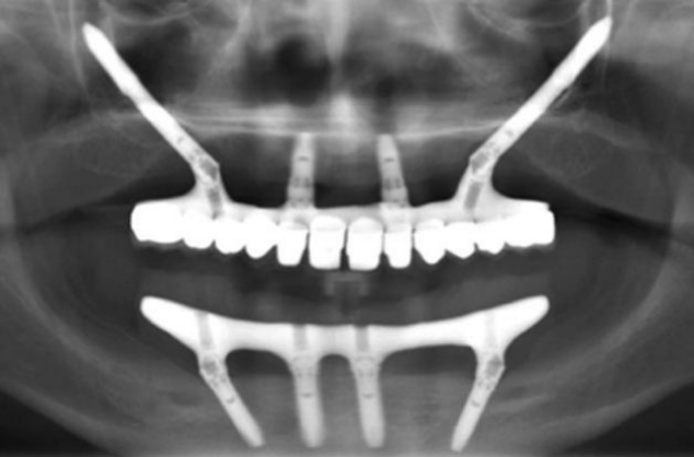 Использование скуловых имплантатов Nobel Zygoma на верхней челюсти