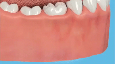 РОЛИК 110. Образование глубоких пародонтальных карманов и появление подвижности зуба