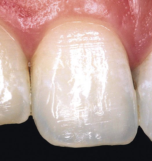 микро-рельеф поверхности зуба